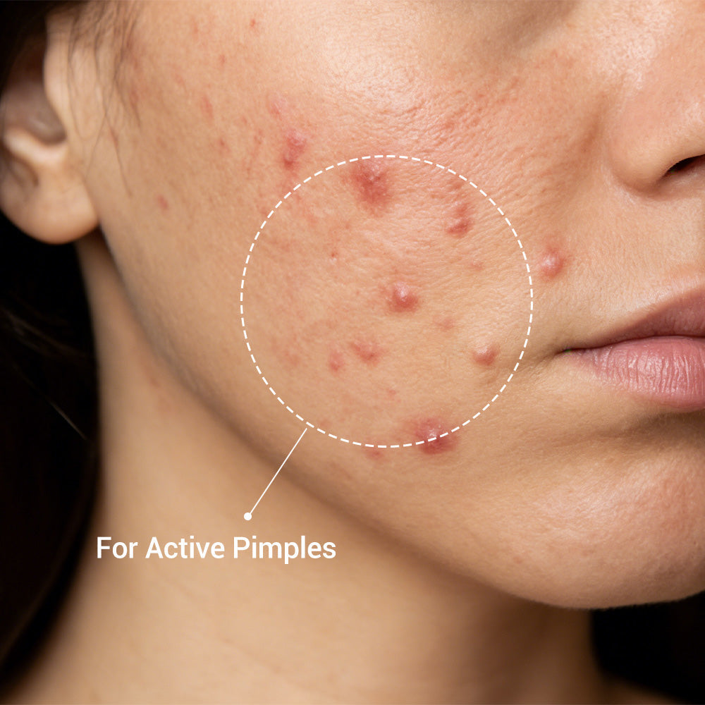 Acne Drying Lotion Plus (1.8% Encapsulated Salicylic Acid) — 20 mL