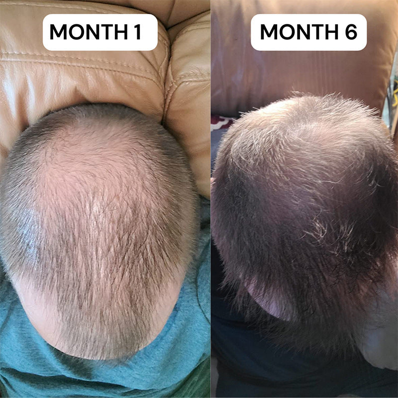 Minoxidil Hair Growth Foam Serum